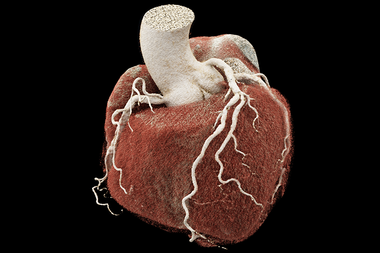 3D cardiac CT and image of heart and coronary arteries using the Siemens NAEOTOM Alpha